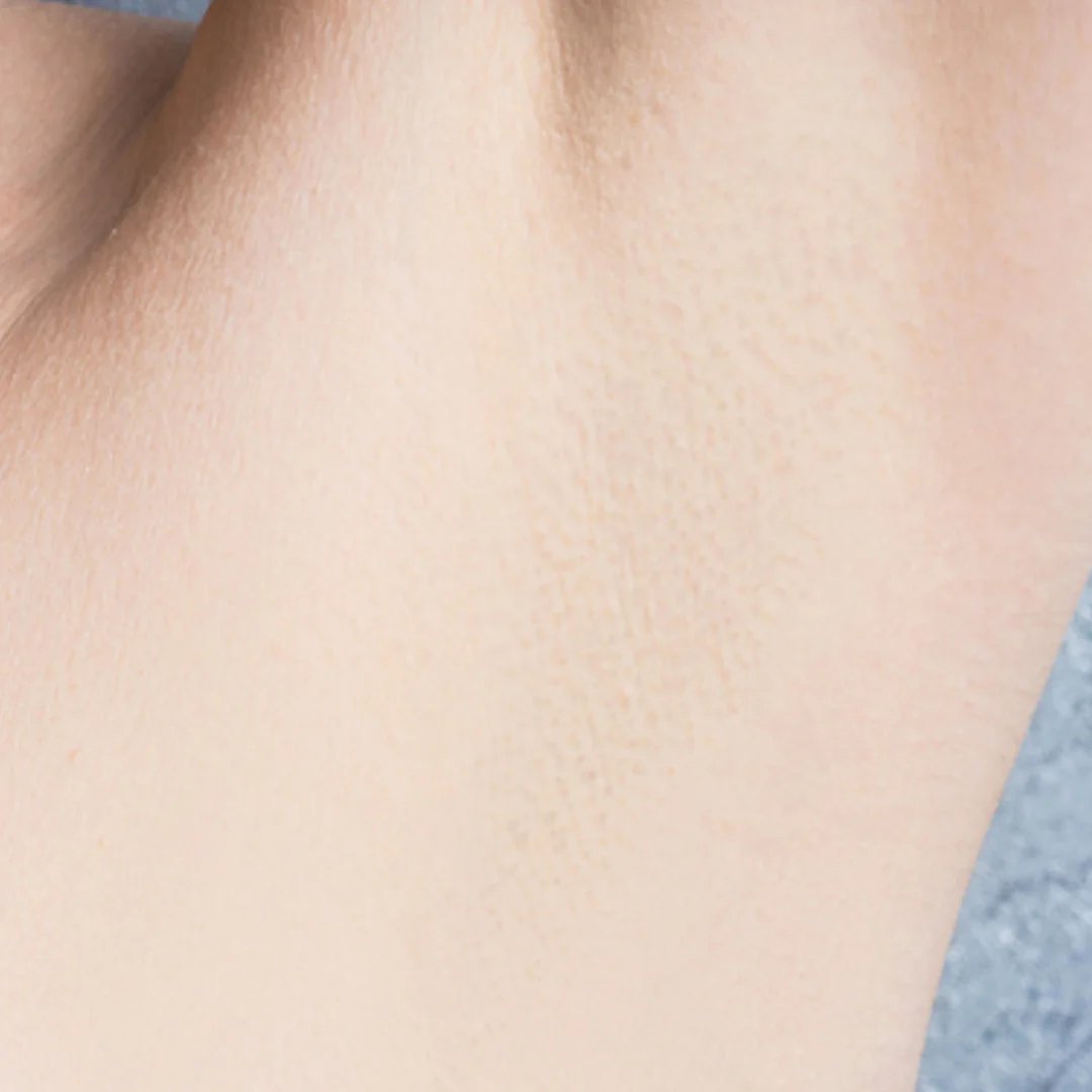 Hair Removal Formula (8).png__PID:46389fe7-ca0b-4157-8ff4-dc783574d882 Hair Removal Formula (8).png__PID:46389fe7-ca0b-4157-8ff4-dc783574d882