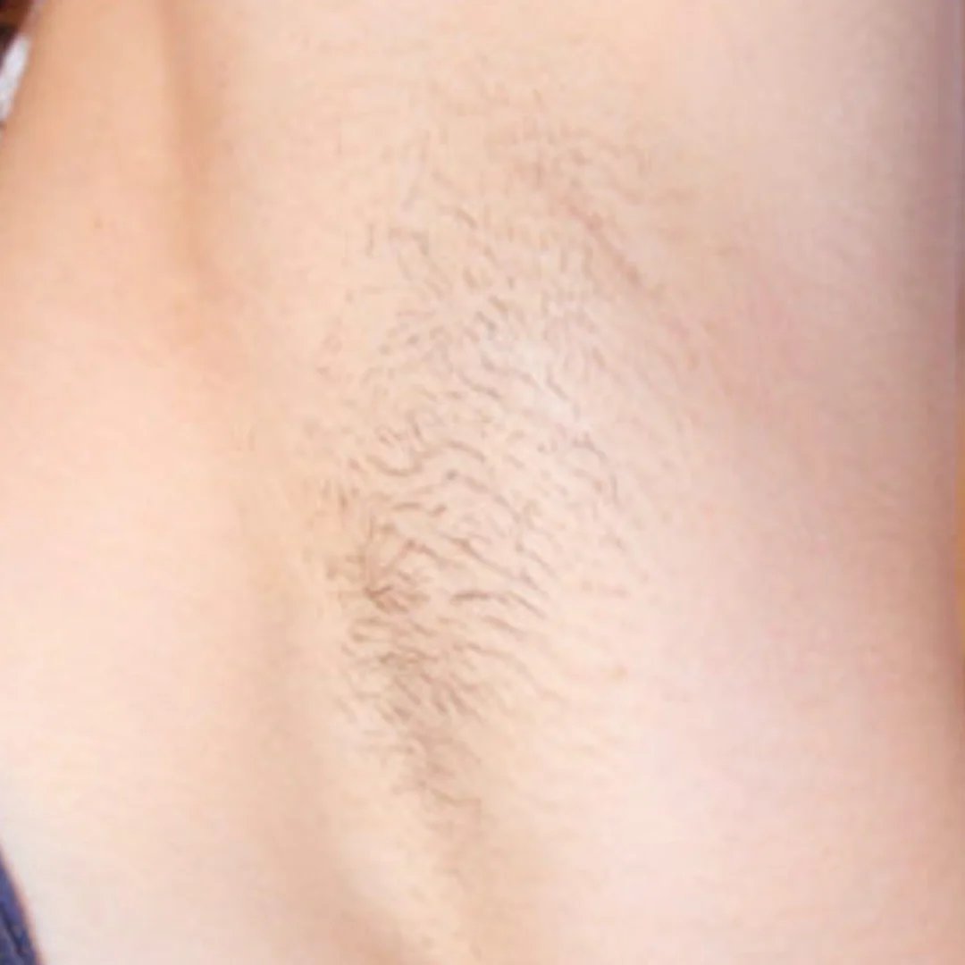 Hair Removal Formula (7).png__PID:389fe7ca-0b51-478f-b4dc-783574d88240 Hair Removal Formula (7).png__PID:389fe7ca-0b51-478f-b4dc-783574d88240